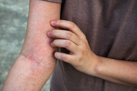 Infections & Rashes - Scottsdale Skin Boutique & Dermatology